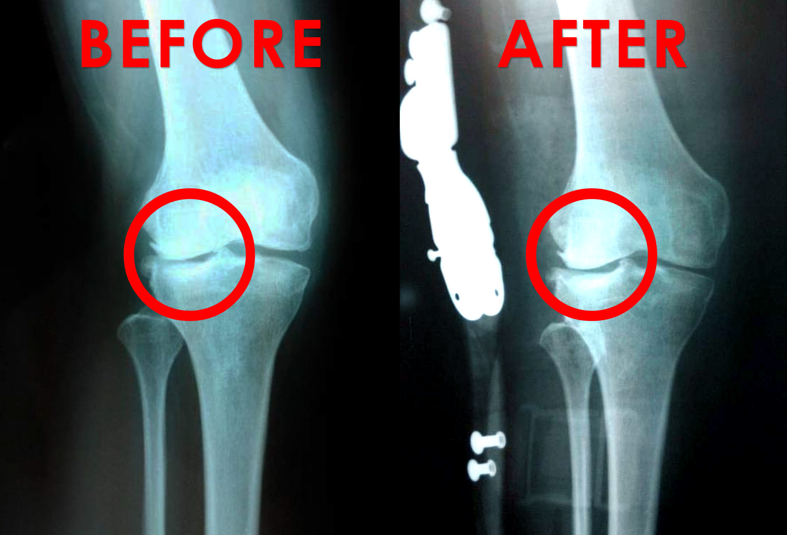 medial unloader knee brace