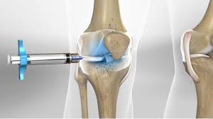 Why We Should Definitely Include Intra-articular Hyaluronic Acid as a Therapeutic Option in the Management of Knee Osteoarthritis: Results of an Extensive Critical Literature Review